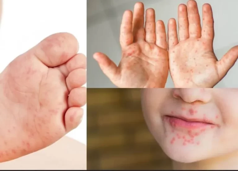 手足口病病毒：巴拿马当局呼吁加强儿童卫生防护